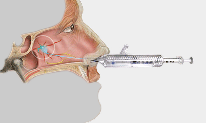 NEW! Painless Sphenopalatine Ganglion  Block for Intractable Headaches
